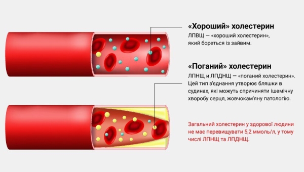 «Хороший» і «поганий» холестерин: норма і відхилення